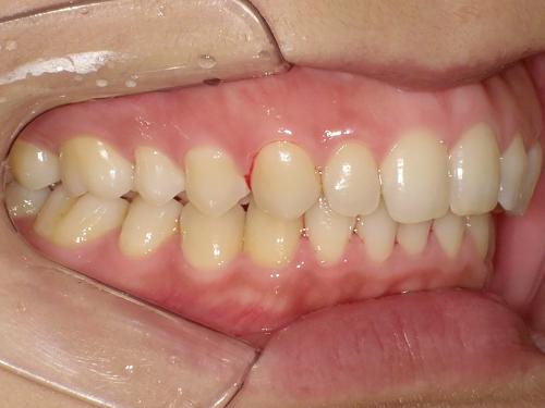 部分矯正事例after