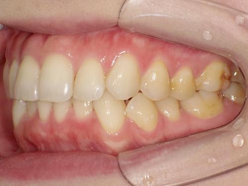 部分矯正事例after