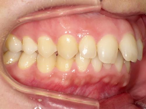 部分矯正事例before