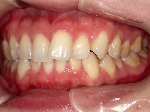 部分矯正事例before