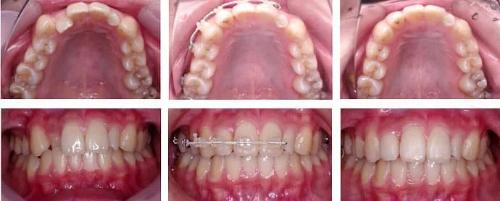 右上前歯 表側装置 部分矯正 Before_After