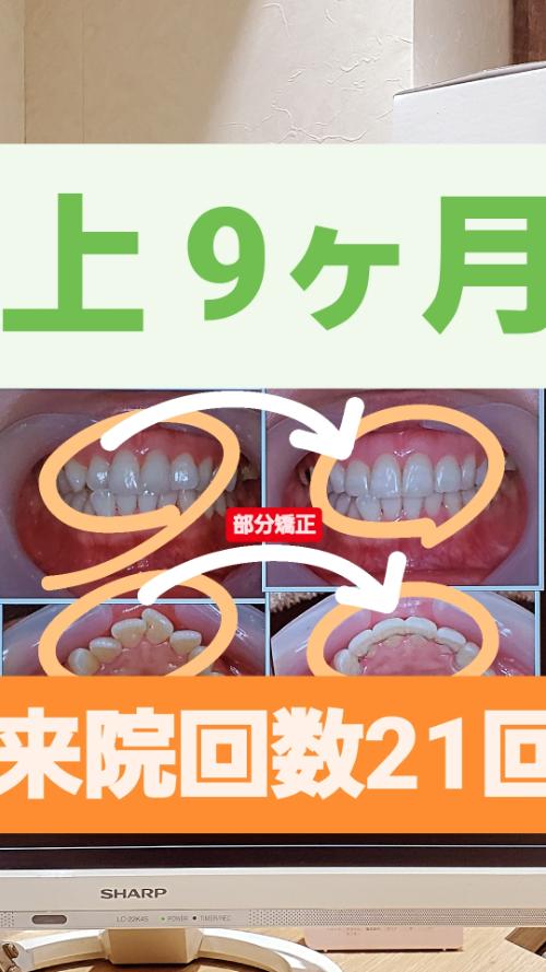 部分矯正事例beforeafter