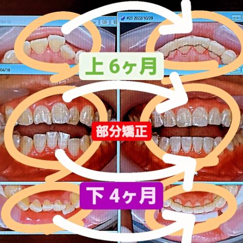 部分矯正事例beforeafter