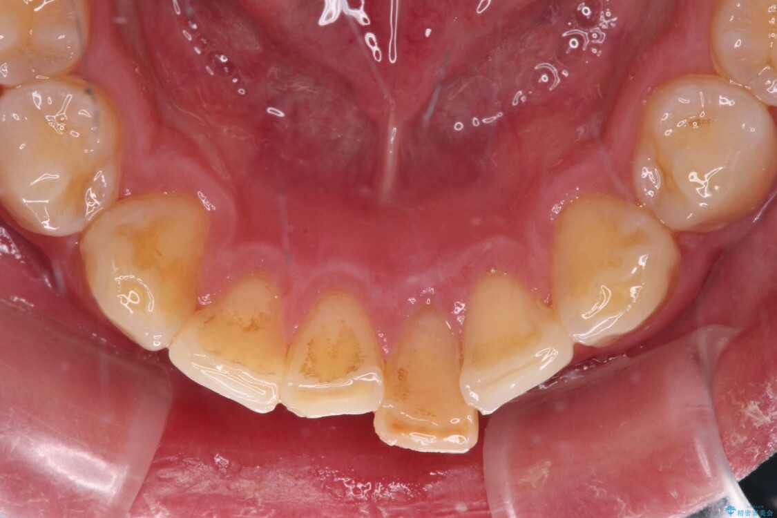 部分矯正事例before